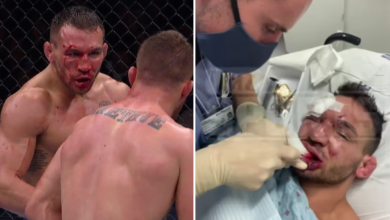 (VIDEO) Twarz Michaela Chandlera zmasakrowana po walce na UFC 267. Lekarz założył mu 22 szwy!